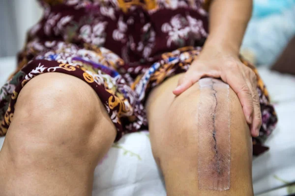 アジアの高齢者や高齢者の女性患者は 彼女の傷手術総膝関節置換縫合テープで創傷を示しています 手術後の回復 健康な関節形成の概念は — ストック写真