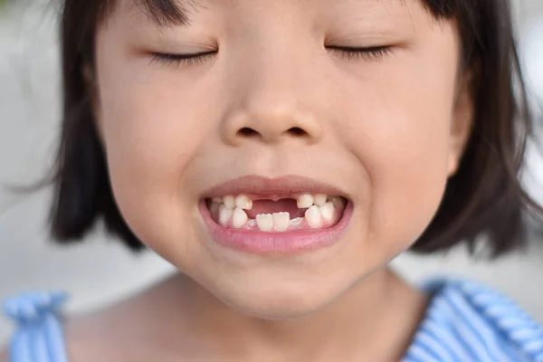 Fofa Menina Sorrir Com Dente Partido Fechar Dente Frente Criança — Fotografia de Stock