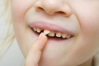 Gülümseyen ve parmağını ile açık ağız içinde titrek süt diş sallayarak bebek kız. İlk azı dişleri. Sağlık, diş hijyeni ve çocukluk kavramı.