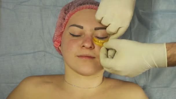 Un cosmetologo maschile in un guanto mette pastiglie di collagene su palpebre inferiori delle donne. Giri temporali — Video Stock