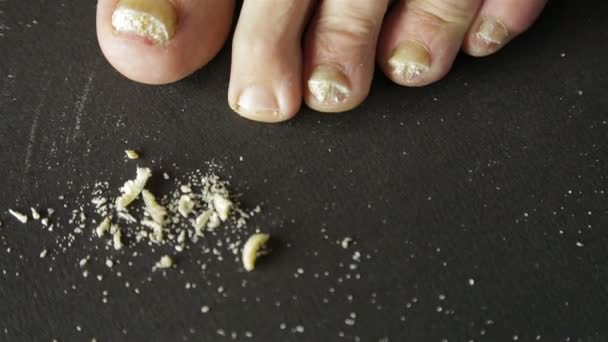 Clipped toenails of men affected by fungus — Stock Video