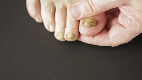 Инфекционный грибок на ногтях пальцев ног человека — стоковое видео
