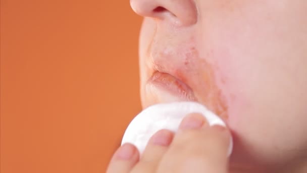 Una mano femminile lubrifica una vera bruciatura sul viso con un disinfettante — Video Stock