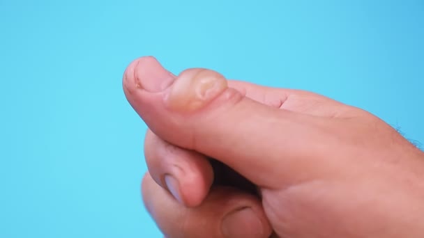 Mousse Medizin wird auf die Blase einer Verbrennung an einem Finger auf blauem Hintergrund aufgetragen. — Stockvideo