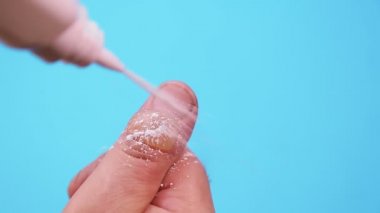 Küf ilacı, mavi arka plandaki bir parmak yanığının kabarcıklarına uygulanır.