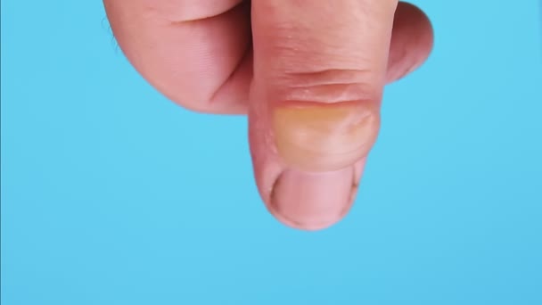 Brandblasen an einem Finger auf blauem Hintergrund — Stockvideo