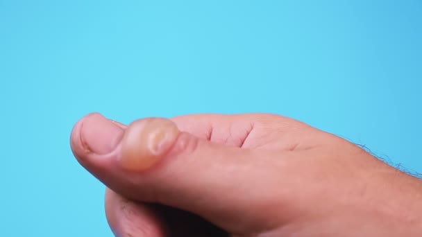 Blister Una Quemadura Dedo Sobre Fondo Azul Plan Medio — Vídeo de stock