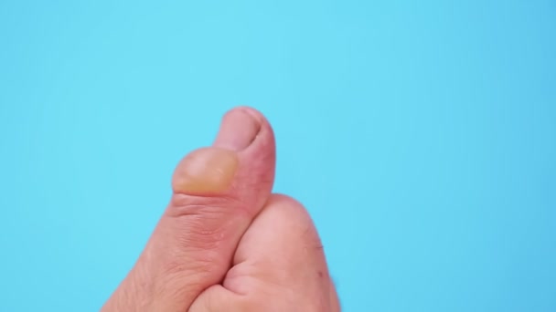 Una ampolla grande de una quemadura en el dedo de la mano de un hombre sobre un fondo azul — Vídeos de Stock