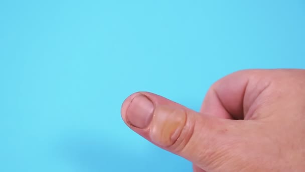 Blistr z popáleniny na mužském prstu na modrém pozadí. — Stock video