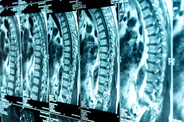 MRI of the thoracic spine