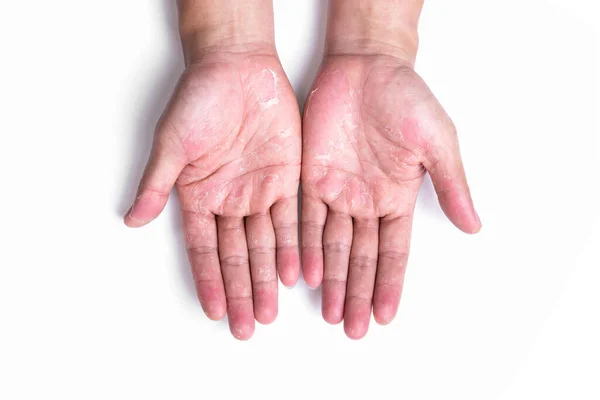 Dry Hands Peel Dermatitis Allergic Chemicals Eczema — Stock Photo, Image