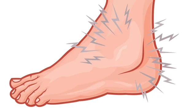 Ilustrasi Vektor Sprain Ankle - Stok Vektor