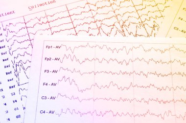 EEG elektrofizyolojik izleme yöntemi. EEG dalga insan beyin, beyin dalga kalıpları üzerinde electroencephalogram, çocuğun, Eeg beyin elektriksel aktivitesinin sorunları algılamak