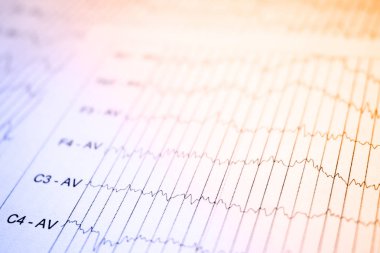 EEG elektrofizyolojik izleme yöntemi. EEG dalga insan beyin, beyin dalga kalıpları üzerinde electroencephalogram, çocuğun, Eeg beyin elektriksel aktivitesinin sorunları algılamak. seçici odak