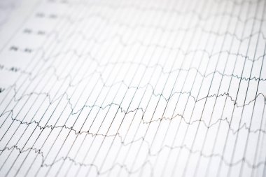 EEG elektrofizyolojik izleme yöntemi. EEG dalga insan beyin, beyin dalga kalıpları üzerinde electroencephalogram, çocuğun, Eeg beyin elektriksel aktivitesinin sorunları algılamak. seçici odak