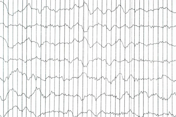 Метод Электрофизиологического Мониторинга Ээг Ээг Волна Человеческом Мозге Мозговые Волны — стоковое фото