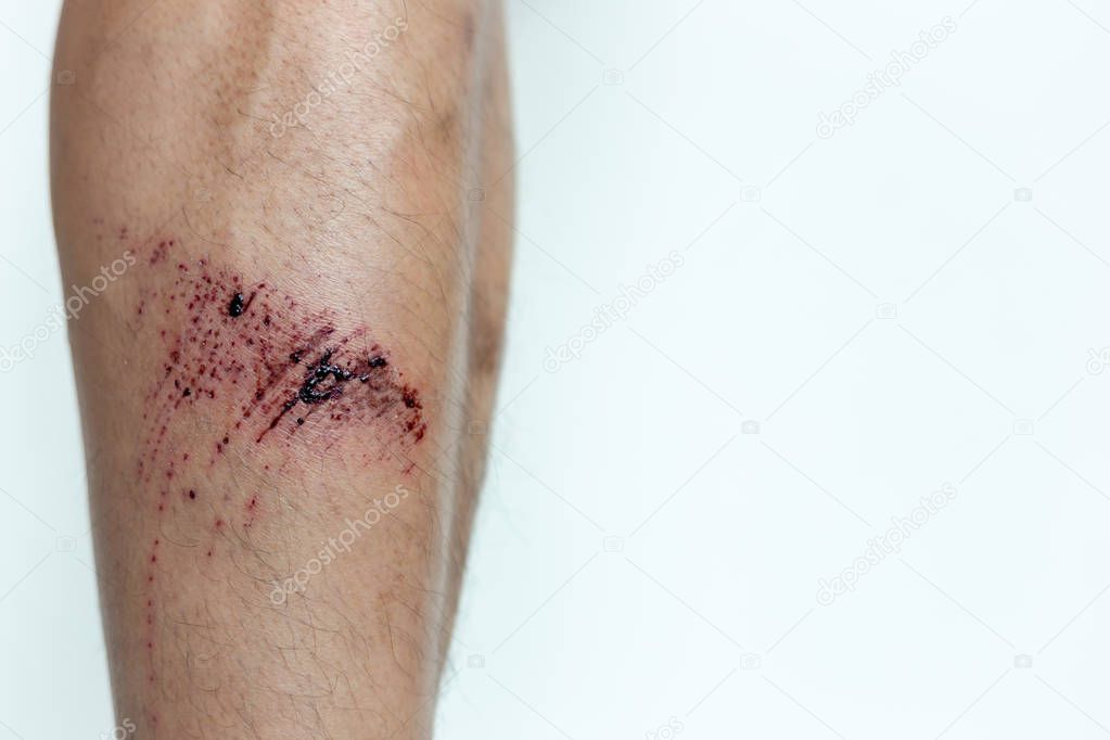 The wound form scabs. The wound happen during young man playing footbal and fall down on the footbal field. He get injured at his shin. It is big wound and abrasions. copy space