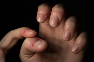 Kafkas kadınının elinde görülen dermatofaji bozukluğu. Yakın çekim, siyah üzerine izole edilmiş..