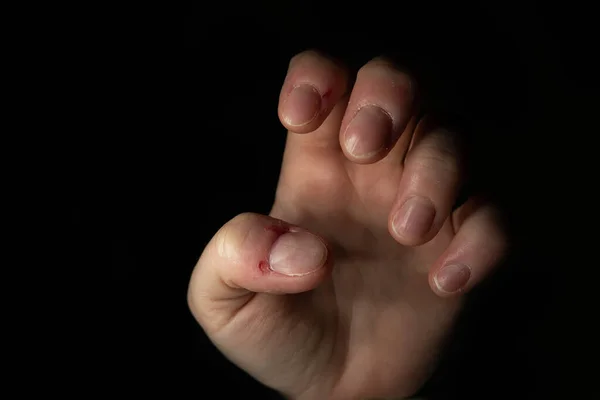 Δερματοφαγία Διαταραχή Φαίνεται Στο Χέρι Καυκάσιας Γυναίκας Κοντά Πυροβόλησε Απομονώνονται — Φωτογραφία Αρχείου