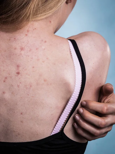 Health Problem Skin Diseases Young Woman Showing Her Back Acne — Stock Photo, Image