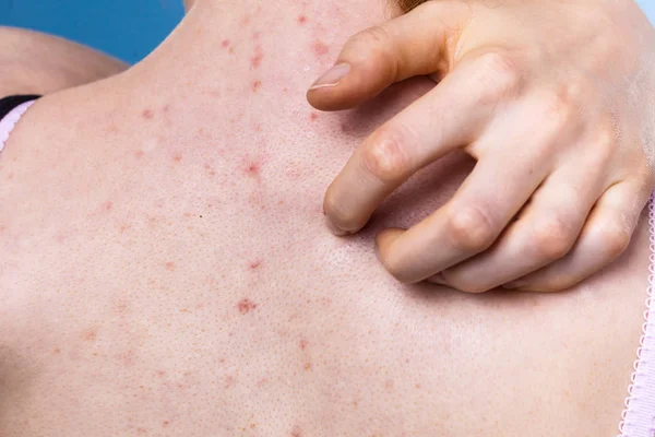 Gezondheidsproblemen Huidziekten Jonge Vrouw Die Haar Rug Laat Zien Met — Stockfoto