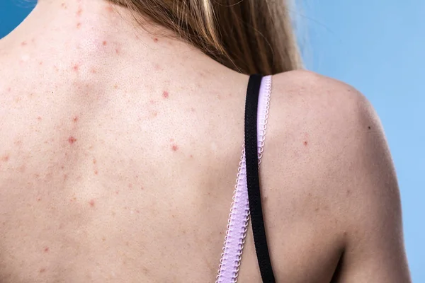 Gezondheidsproblemen Huidziekten Jonge Vrouw Toont Haar Rug Met Allergie Huiduitslag — Stockfoto