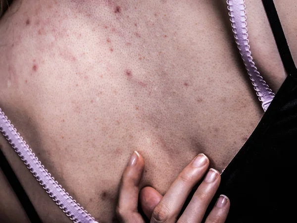 Zdravotní Problém Kožní Onemocnění Mladá Žena Ukazuje Záda Akné Červené — Stock fotografie