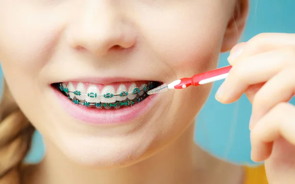Conceito Dentista Ortodontista Mulher Jovem Com Aparelho Azul Limpeza Escovação — Fotografia de Stock