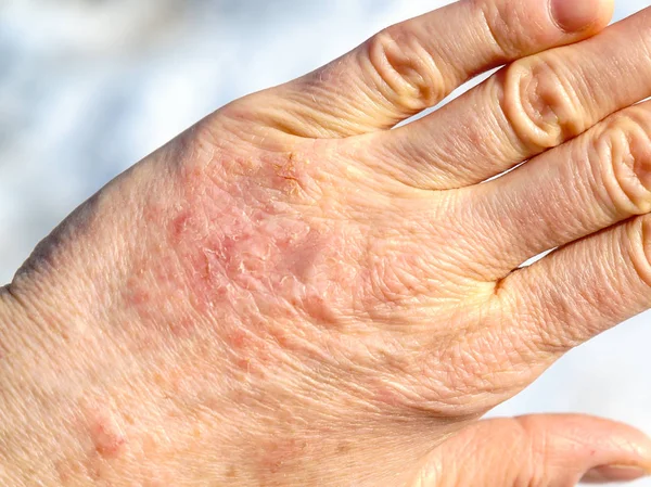 Gedetailleerde Close Van Droge Rijpe Vrouw Hand Hand Verzorging Dermatologie Rechtenvrije Stockafbeeldingen