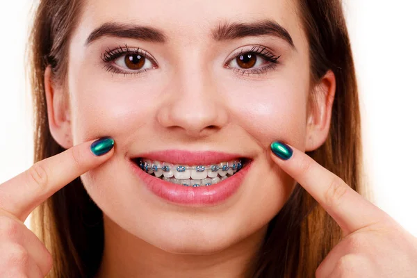 Zubař Ortodontista Žena Úsměv Ukazuje Své Bílé Zuby Modrými Rovnátky — Stock fotografie