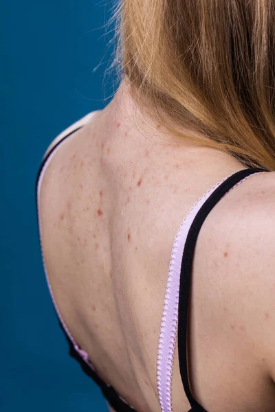 Health problem, skin diseases. Young woman showing her back with allergy rash acne