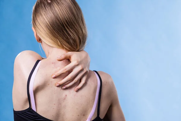 Problema Saúde Doenças Pele Jovem Mostrando Suas Costas Com Acne — Fotografia de Stock