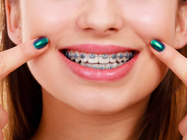 Dentist Orthodontist Concept Woman Smile Showing Her White Teeth Blue — Stock Photo, Image