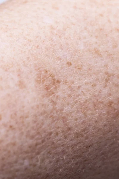 Χροιά Αποχρωματισμός Του Δέρματος Υπέρχρωση Κοντινό Skinblemishes Δερματολογίας Έννοια Της — Φωτογραφία Αρχείου