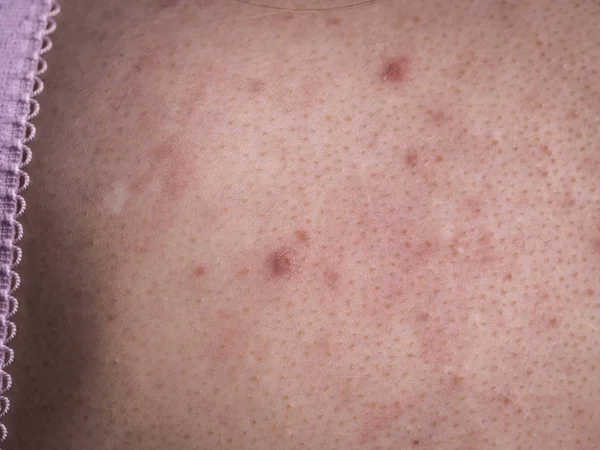 Problema Saúde Doenças Pele Costas Humanas Com Acne Manchas Vermelhas — Fotografia de Stock