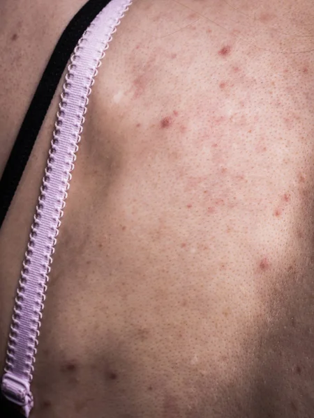 Problema Salud Enfermedades Piel Mujer Joven Mostrando Espalda Con Alergia — Foto de Stock