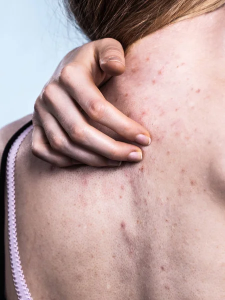 Health Problem Skin Diseases Young Woman Showing Her Back Acne — Stock Photo, Image