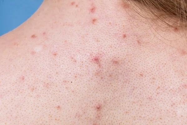 Health problem, skin diseases. Human back with acne, red spots, pimples.