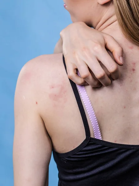 Problema Salud Enfermedades Piel Mujer Joven Mostrando Espalda Con Acné — Foto de Stock
