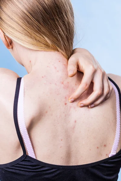 健康上の問題皮膚病 若い女性がにきび 赤い斑点で彼女の背中を示しています Teen Girl Scratching Her Shoulder Pimples — ストック写真