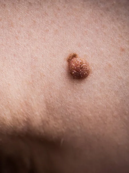 Persona Irriconoscibile Con Fibroma Scuro Problema Dermatologico Sulla Pelle Primo — Foto Stock