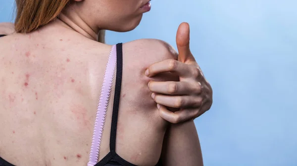 Problema Salud Enfermedades Piel Mujer Joven Mostrando Espalda Con Acné — Foto de Stock