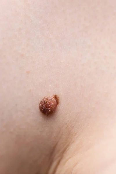 Persona Irriconoscibile Con Fibroma Scuro Problema Dermatologico Sulla Pelle Primo — Foto Stock