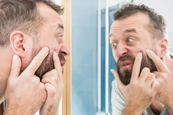 Adult Man Investigating His Pimples Face Guy Trying Get Rid — Stock Photo, Image