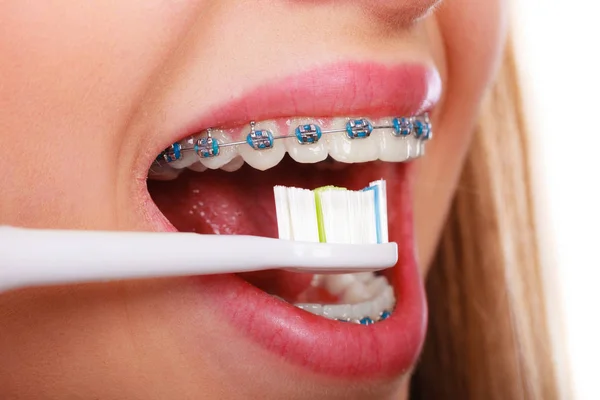 歯医者と歯医者の概念 歯ブラシを使用して青のブレースで歯を洗浄し ブラッシング若い女性 — ストック写真