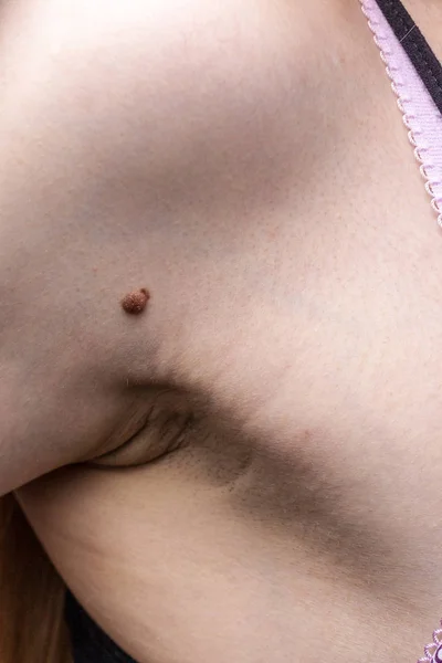 Tanımlanamayan Kişi Koyu Fibroma Dermatoloji Problemi Var Papilloma Dermatozunu Kapat — Stok fotoğraf
