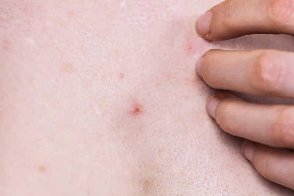 Kvinna Med Finnar Röda Prickar Dermatoser Hudproblem Dermatologiska Problem Puberteten — Stockfoto