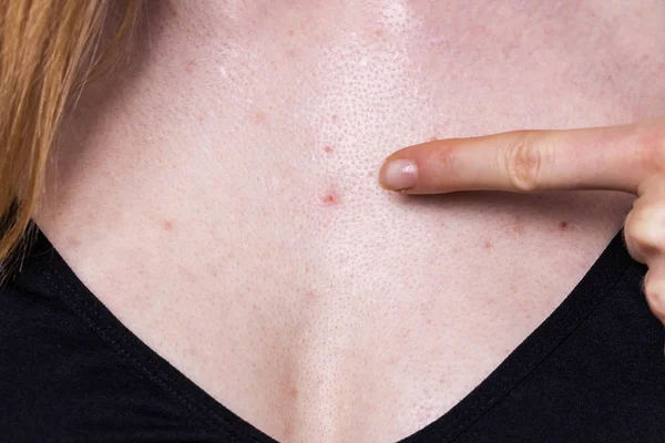 Mujer Con Granos Manchas Rojas Pecho Dermatosis Problemas Piel Problemas — Foto de Stock