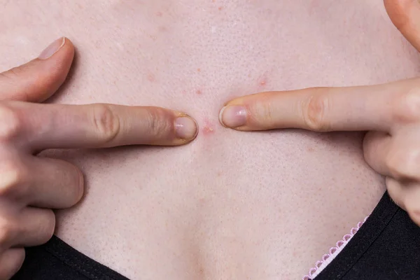 Woman having pimples red spots on chest — Stock Photo, Image