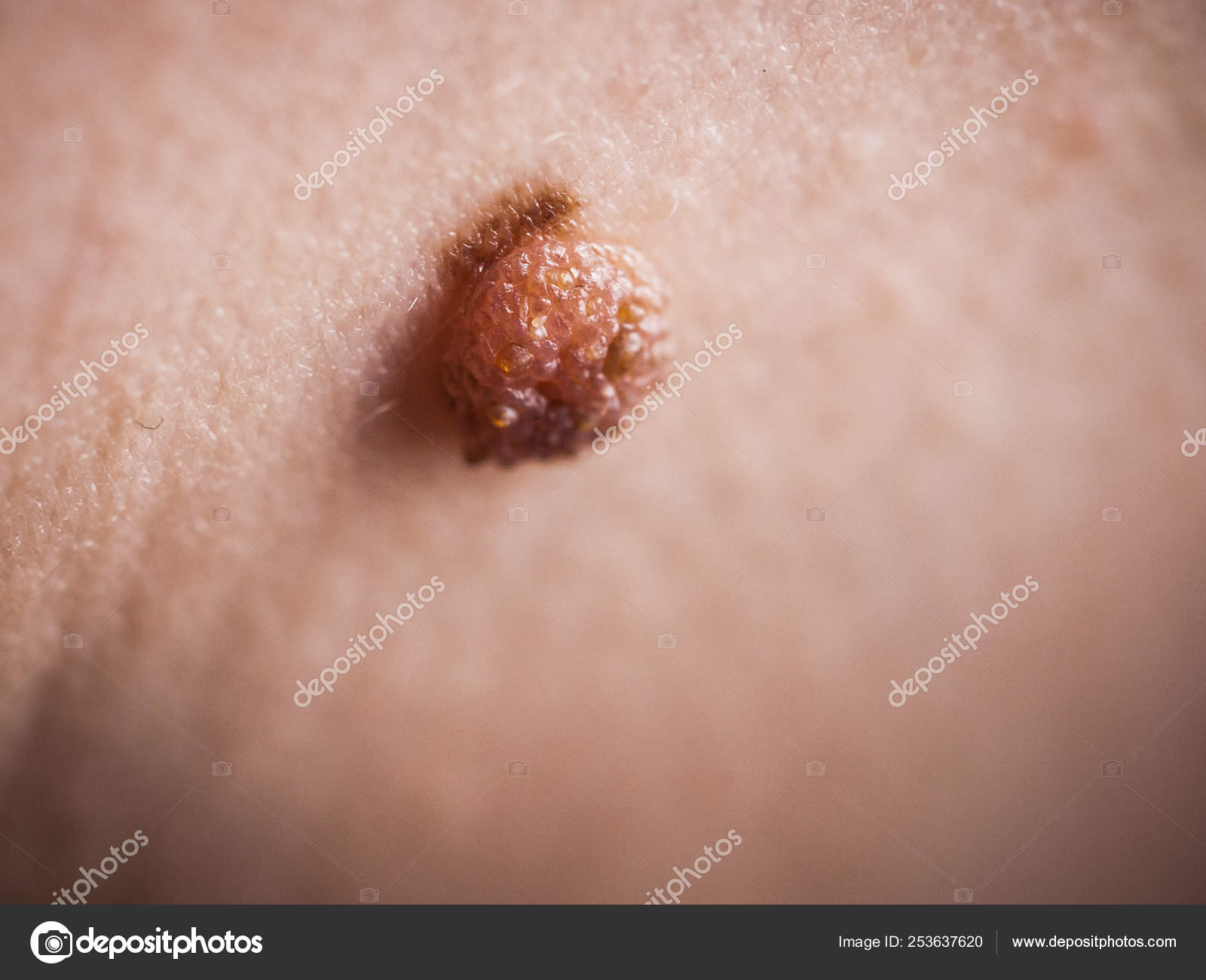 papilloma skin